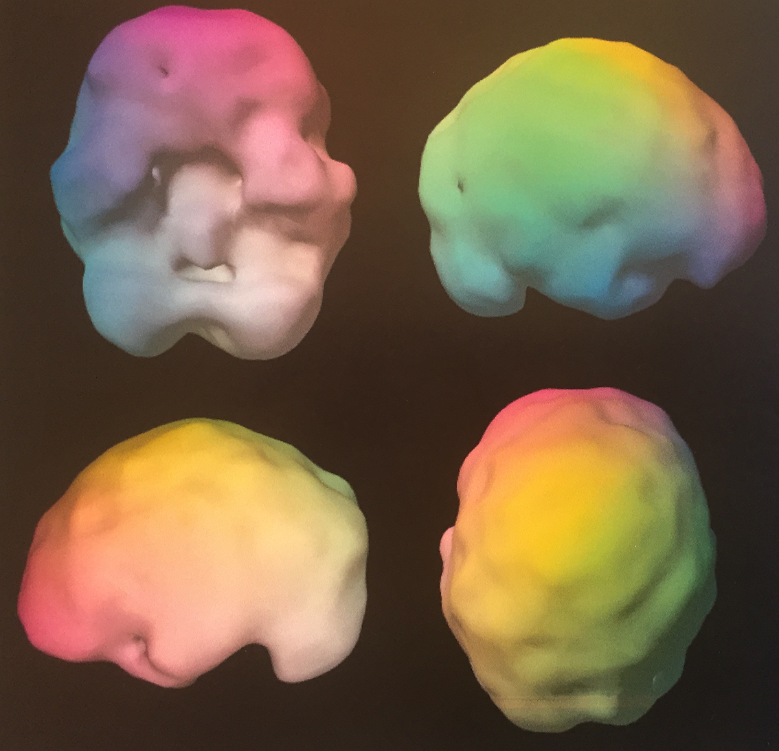 SPECT scan of the brain: Underactivity after concussion is seen here on the frontal lobe, left temporal lobe and around the brainstem