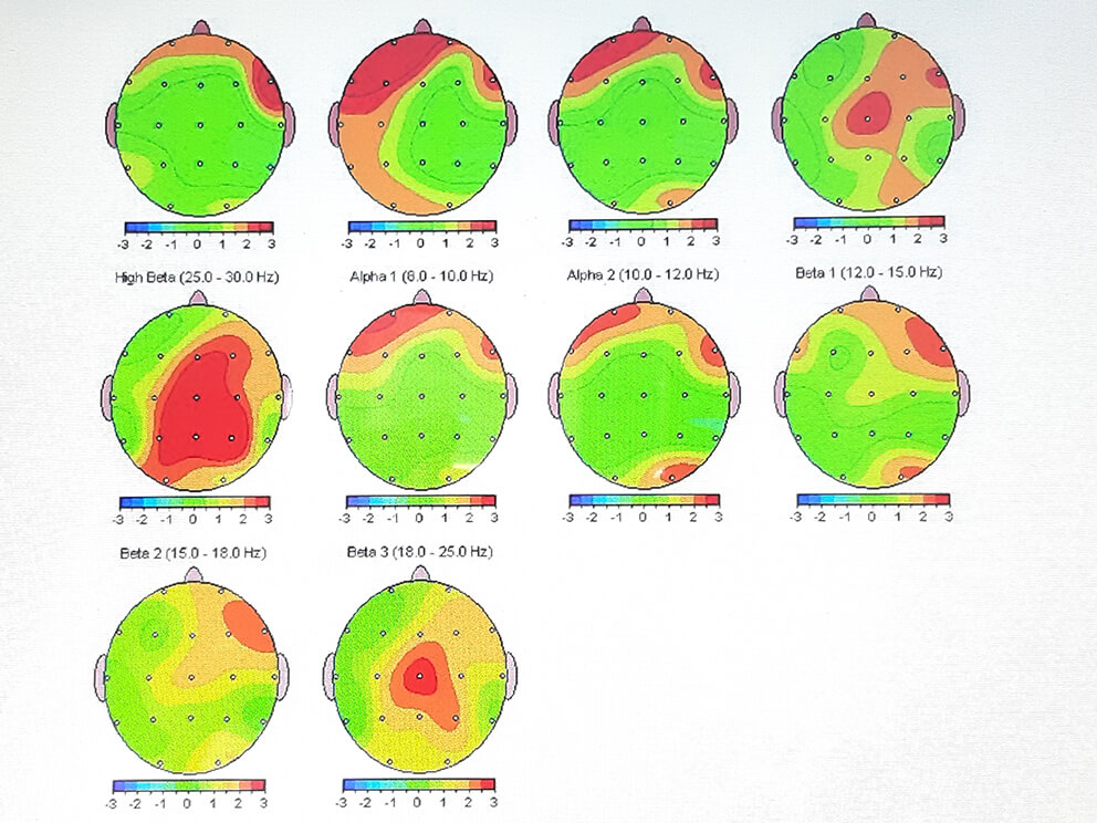 QEEG brain mapping