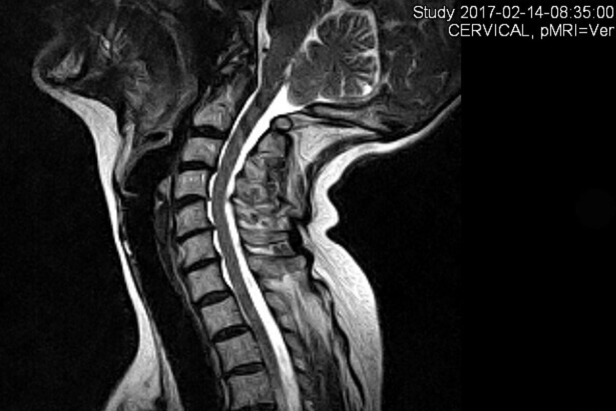 Skade efter piskesmæld /whiplash afsløret af opretstående funktionel MR scanning (med hovedet i ydrestillinger)